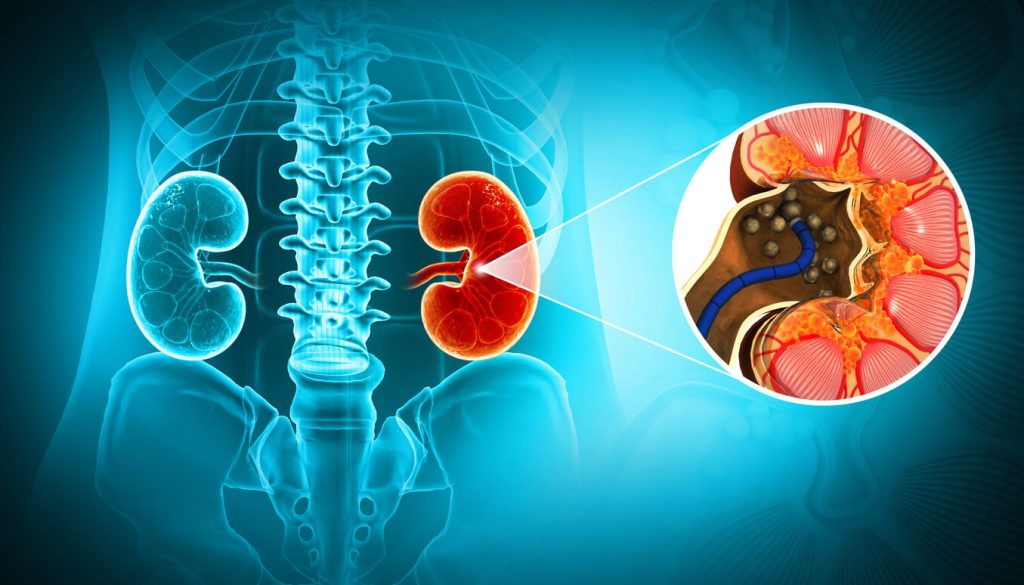 klinik nur medicare kidney stone