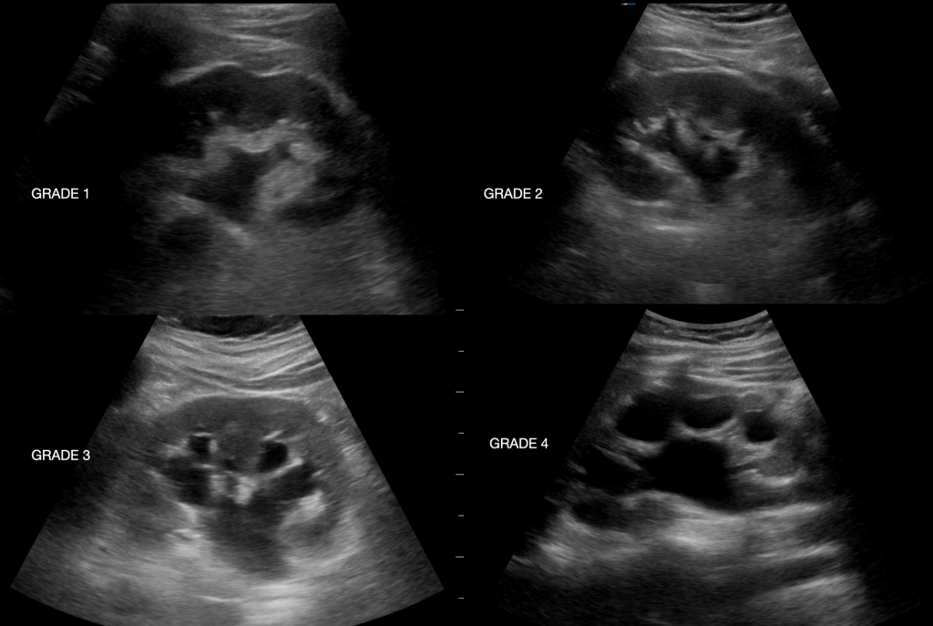 klinik nur medicare Hydronephrosis